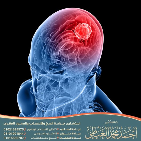 علامات تدل على وجود ورم في الدماغ
